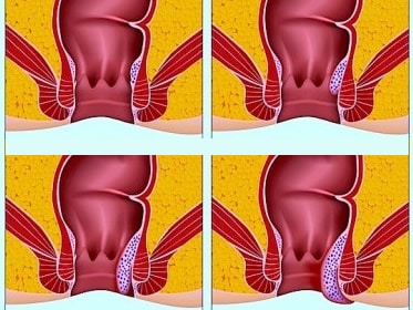 Si può ottenere emorroidi dal sesso anale