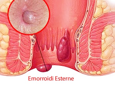 sesso anale dopo la chirurgia delle emorroidi